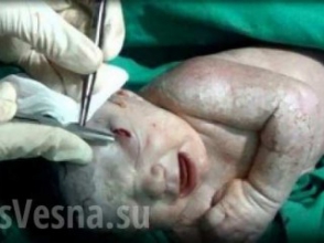 В Сирии родился ребенок с осколком снаряда в голове (видео)